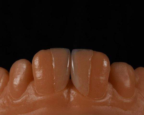 Emax Veneer