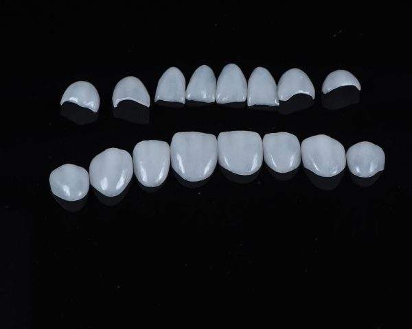 Emax Veneer