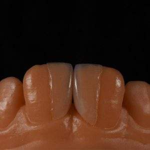 Emax Veneer