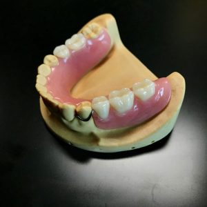 Arcrylic Partial Denture
