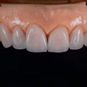 Emax Crown
