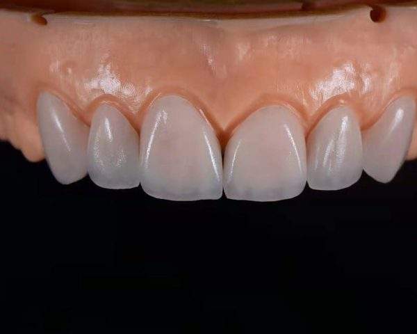 Emax Crown