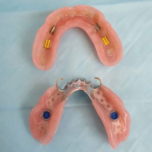 Impant denture