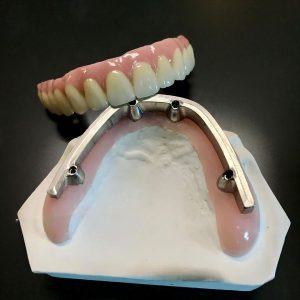Implant bridge