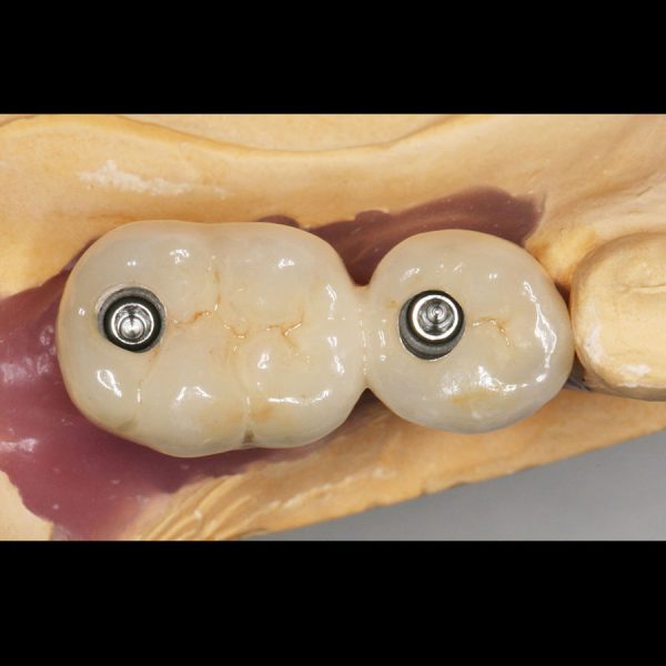 Implant bridge