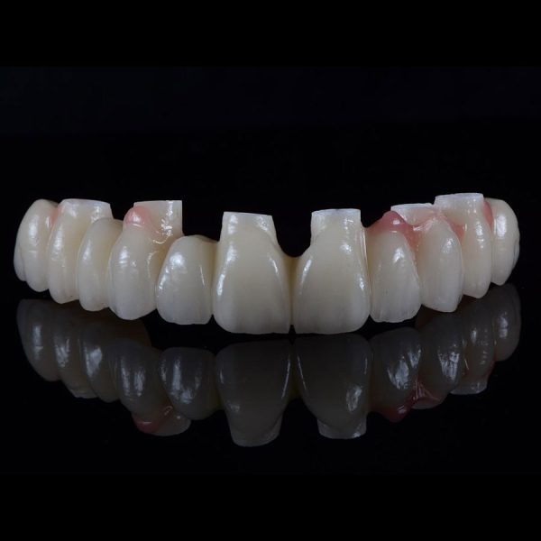 Implant bridge