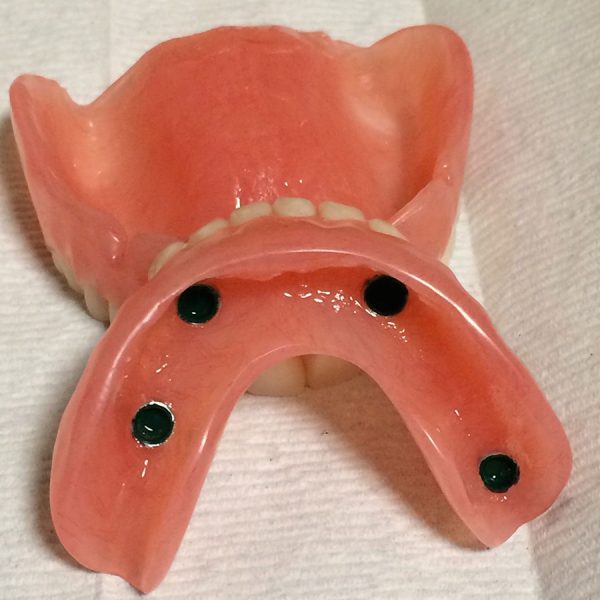 Impant denture