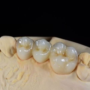 Layered zirconia bridge
