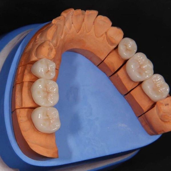 Layered zirconia bridge