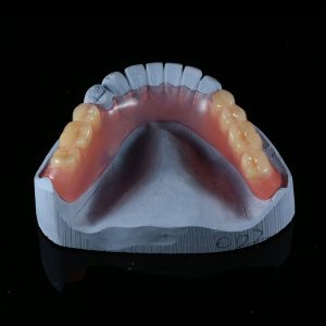 Valplast partial denture
