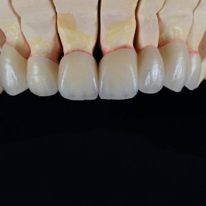 Zirconia bridge