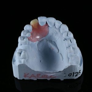 Nesbit Valplast Partial Denture