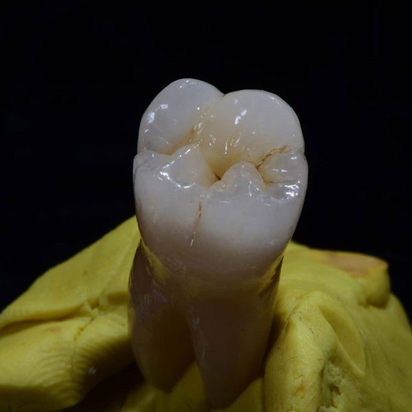 Layered Zirconia Crown