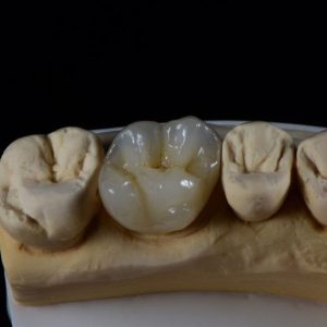 Layered Zirconia Crown