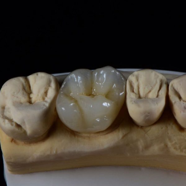Layered Zirconia Crown