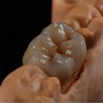 zirconia-crown-1