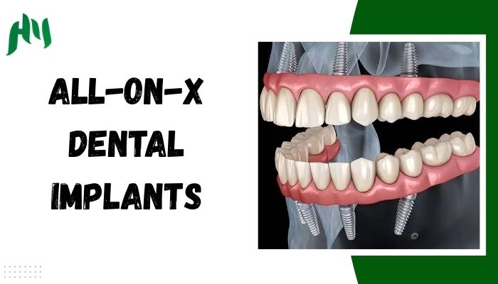 All-on-X Dental Implants